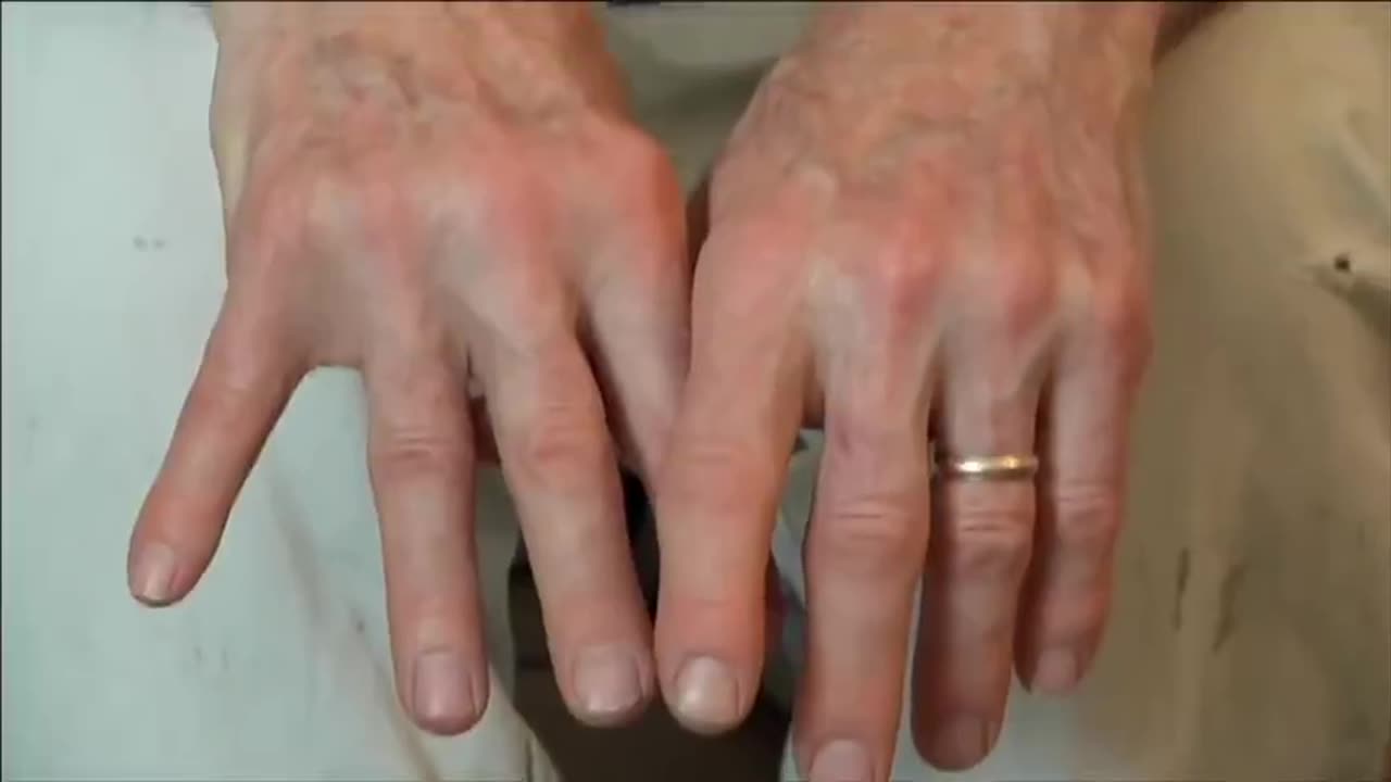 MAN WITH PARKINSONS USES WEED, SEE WHAT HAPPENS