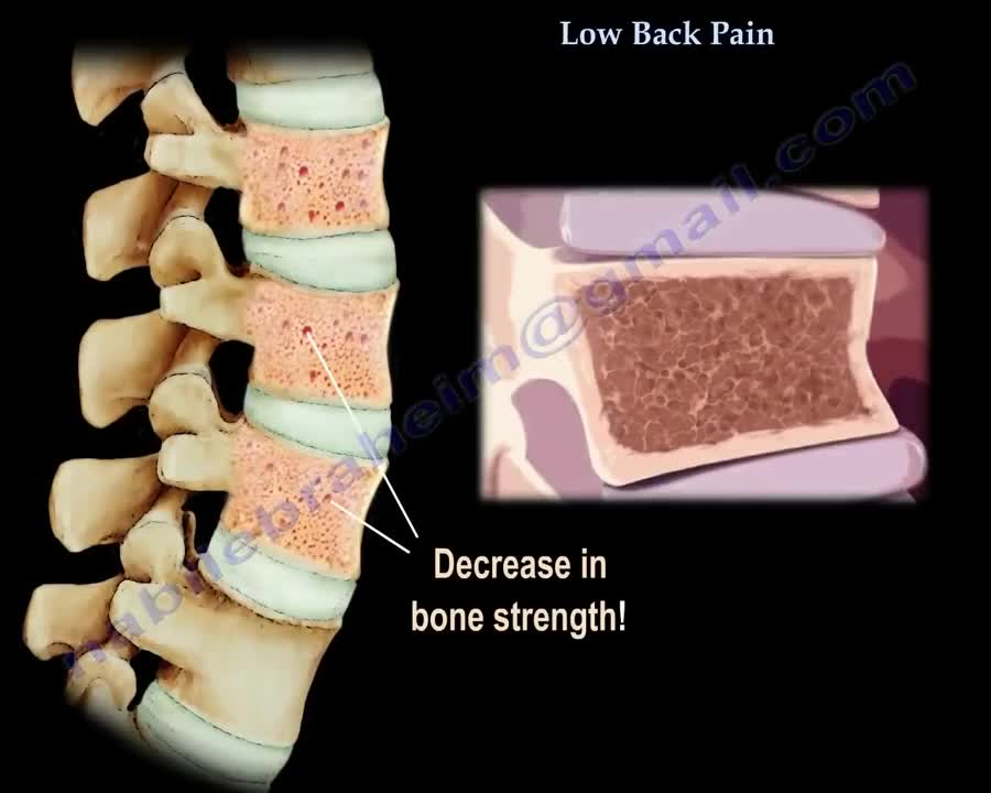 Low Back Pain - Everything You Need To Know