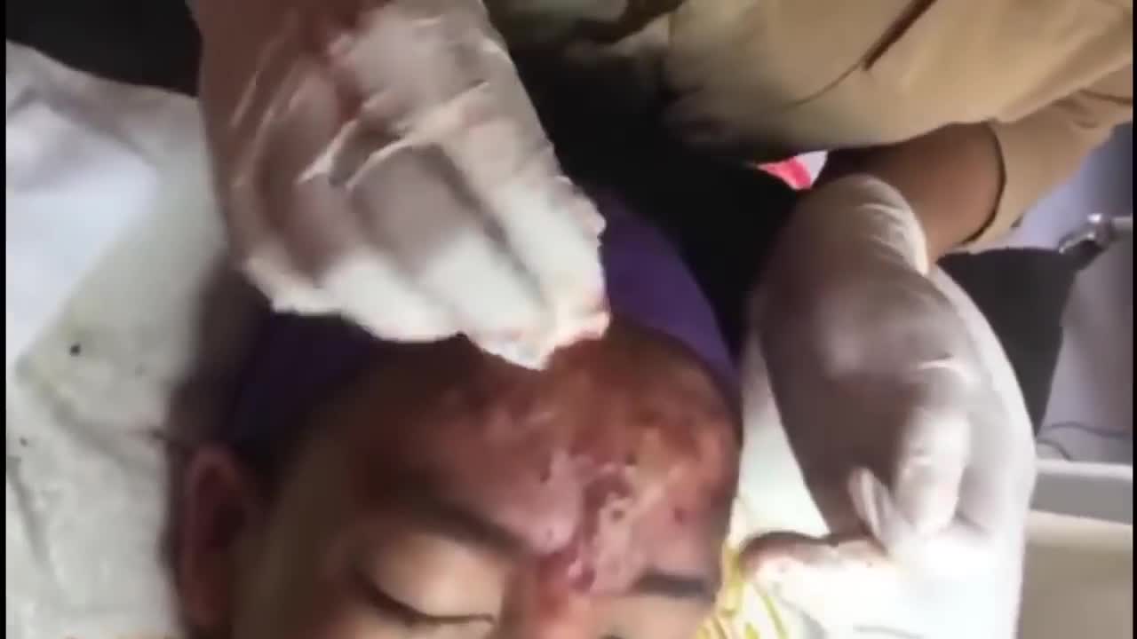 Huge blackhead removal surgery