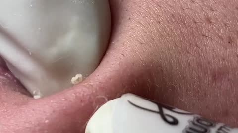 Acne Treatment Huong Da Nang#003