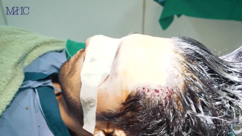 Million Hair transplant Center, Bangkok , Thailand FUE FUT