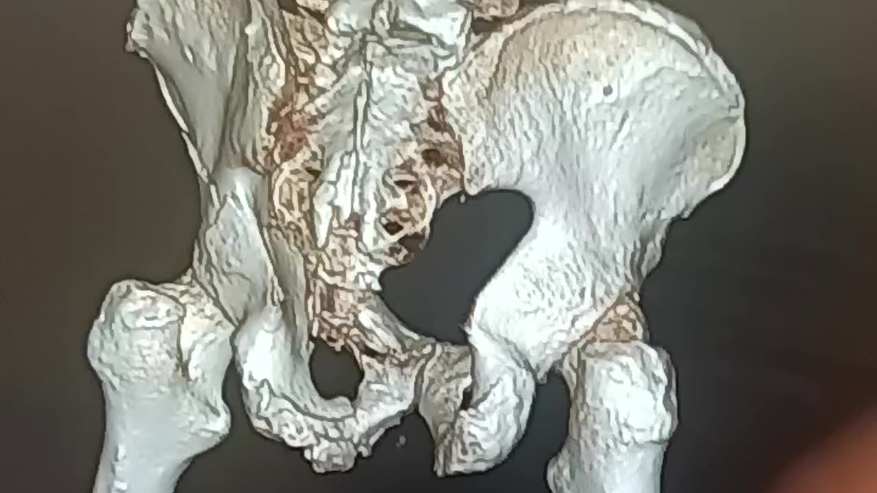 EDH3DPelvis