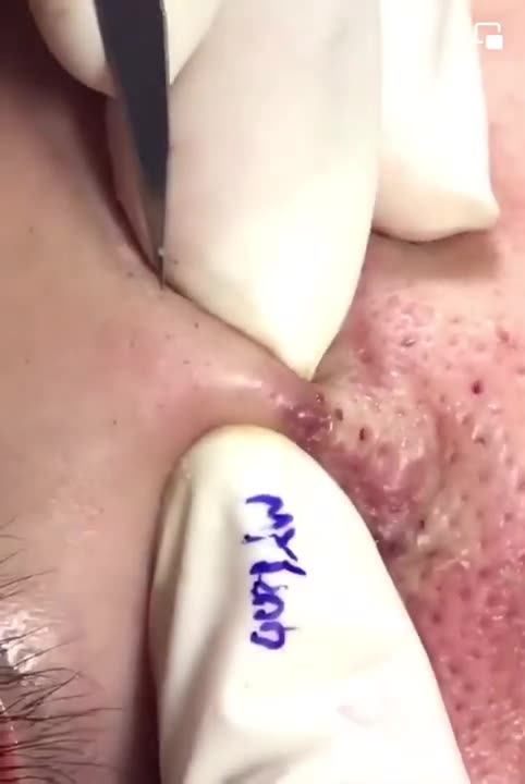 Pimple Popping Acne Treatment Blackhead Extraction