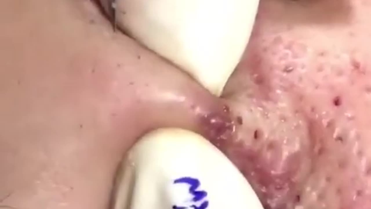 Pimple Popping Acne Treatment Blackhead Extraction