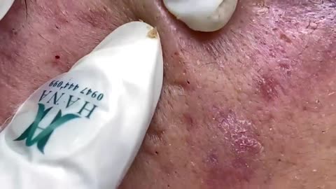 Big Cystic Acne Blackheads Extraction Blackheads & Milia, Whiteheads Removal Pimple Popping