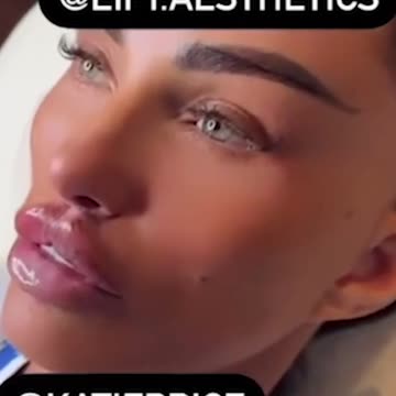 Katie Price reveals she's had yet more lip filler