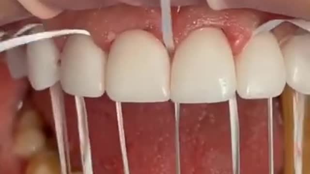 Tartar Dentist 2021 | Satisfying Dental-work