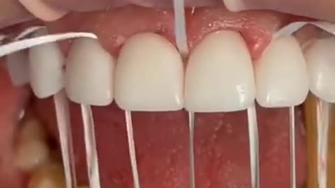 Tartar Dentist 2021 | Satisfying Dental-work