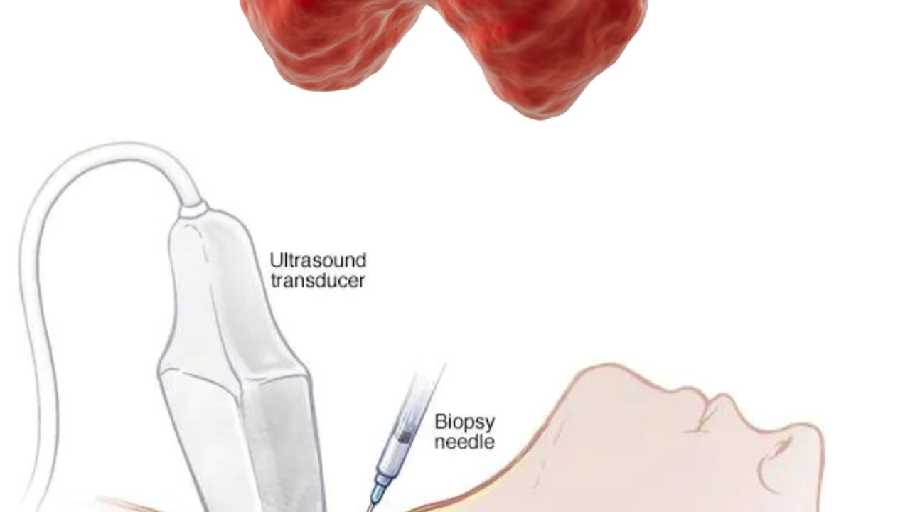 Procedimiento de Biospia de Tiroides