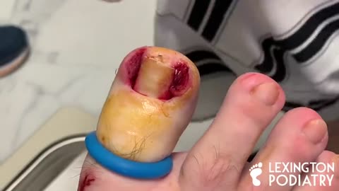 DEEP + BLOODY INGROWN TOENAIL