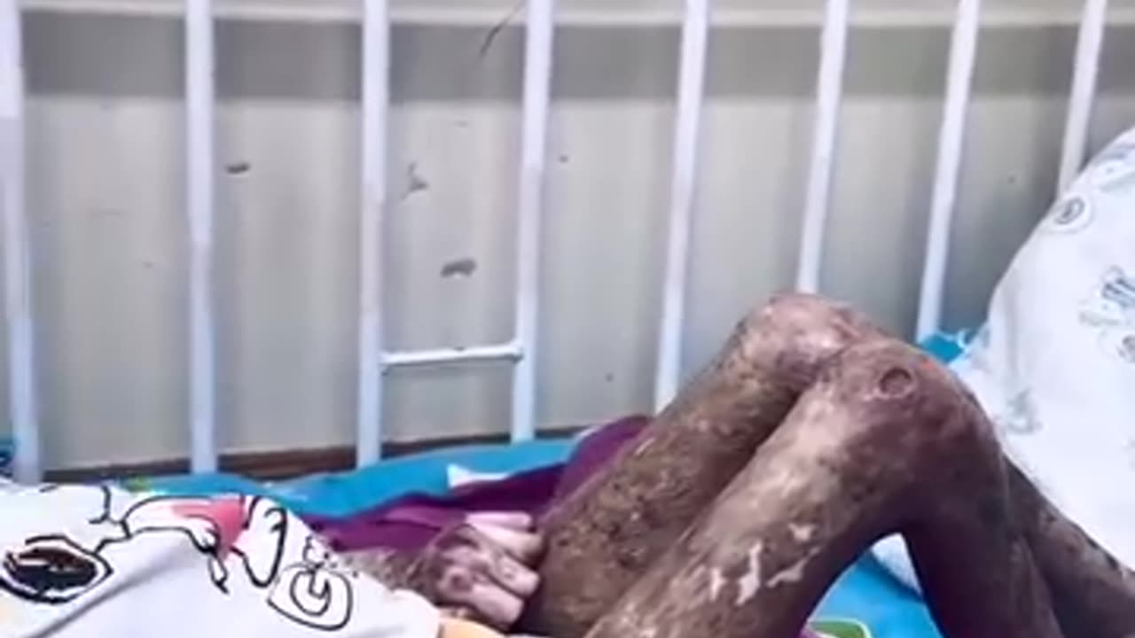 Illegall white phosphorous weapons used on children by israel