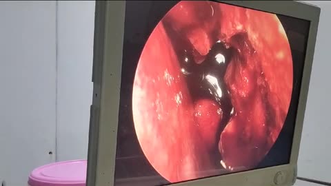 Nose operation