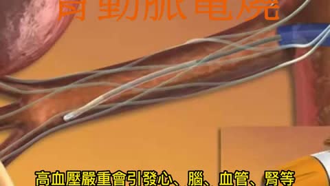 難治型高血壓 腎動脈電燒