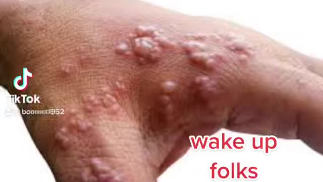 Photos…. Which is it… monkey pox or stingy?
