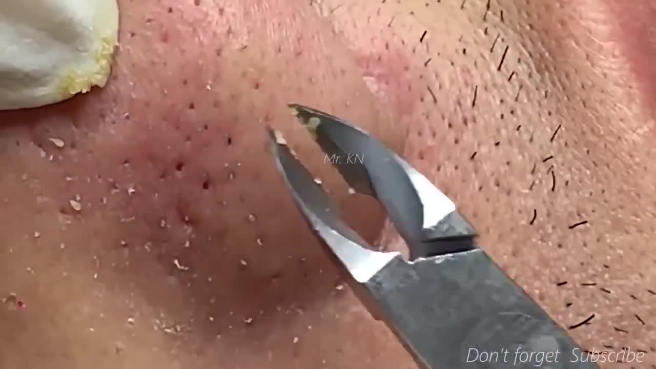 HD Big Cystic Acne Blackheads Extraction Whiteheads Removal Pimple Popping