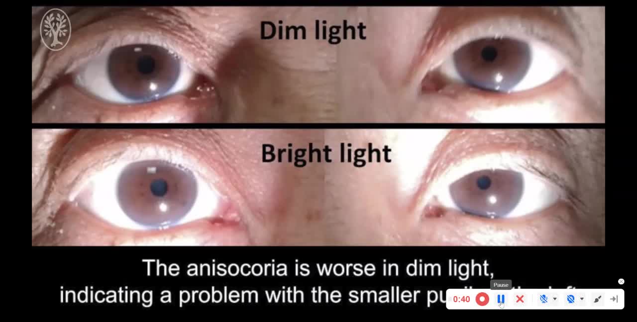 Left sixth cranial nerve palsy with left Horner syndrome localizing to the left cavernous sinus