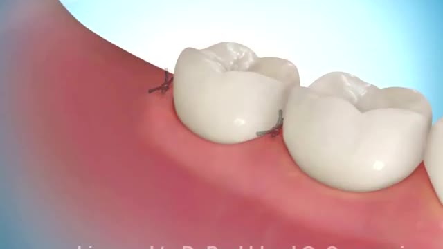 Removing Impacted Wisdom Teeth