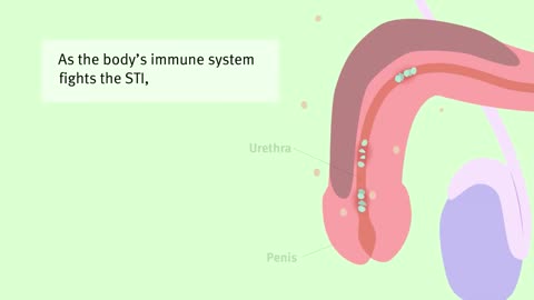 Male Sexual Health Unveiled: The Ins and Outs of Chlamydia