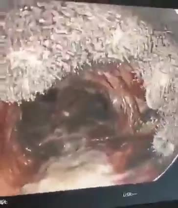 Bronchoscopy on a vaccinated