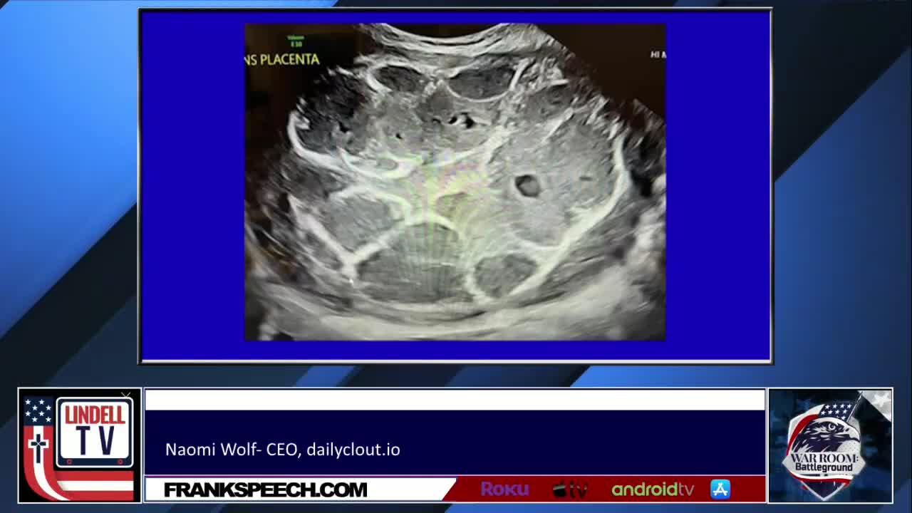Naomi wolf discusses post vaccine placenta
