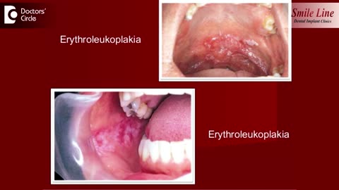 Unraveling the Mystery Causes of Small Red Patches on the Tongue Explained by Dr. Sana Taher