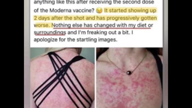 Effetti collaterali da vaccino