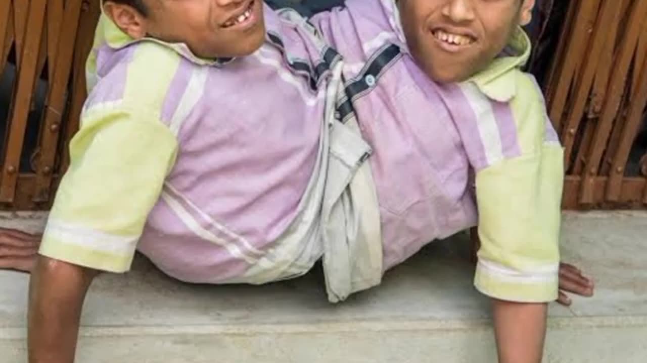8 most unusual twins you won't believe exist