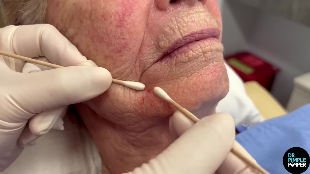 Three Piece Blackhead Combo