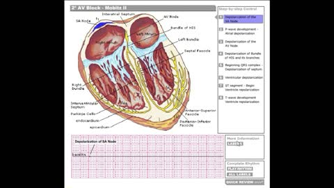 Dr Stanley's ECGcourse.com | Second Degree AV Block, Mobitz II