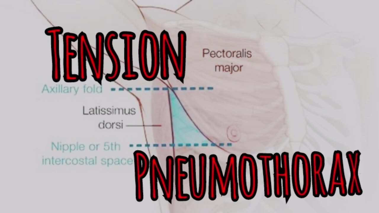 Prolonged Field Care Podcast 119: Tension Pneumothorax