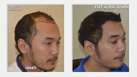 คลินิกปลูกผม Million Hair transplant Center ศัลยกรรมปลูกผม