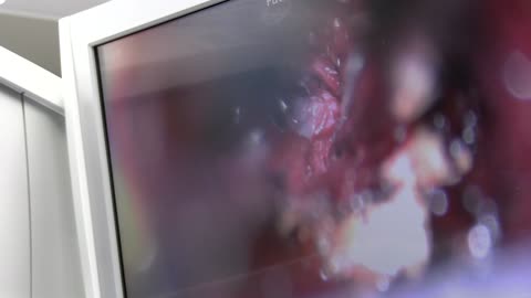 Lumbar Microdiscectomy