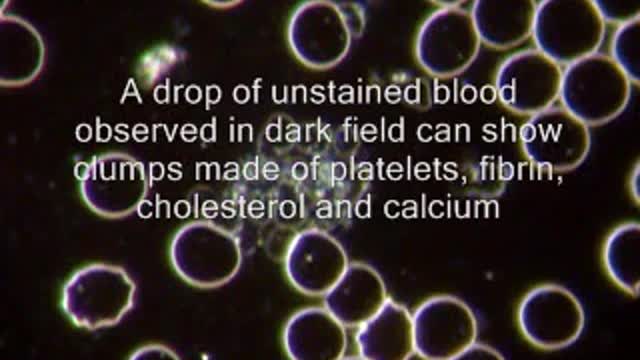 Dark Field Microscopy and Thrombosis