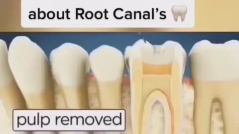 The DARK TRUTH about Root Canal's