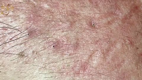 #161 | Acne Treatment Huong beauty