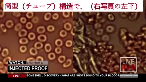 遺伝子ワクチン接種者の血液に一体何が起こっているのか？！ ジェーン・ルビー医師が、顕微鏡下で見たその血液の衝撃的な映像を伝えます！