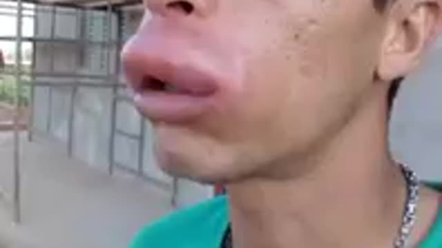 Resolved from wasp bite