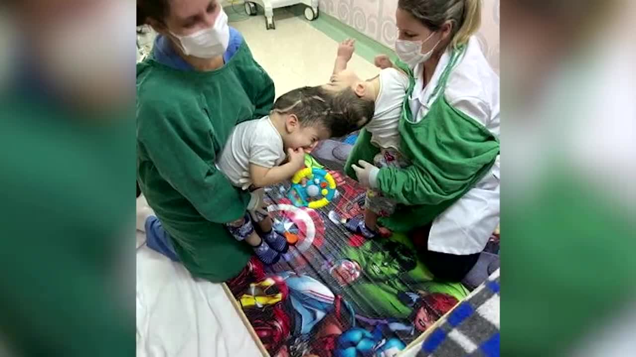 Conjoined twins successfully separated in Brazil - Science