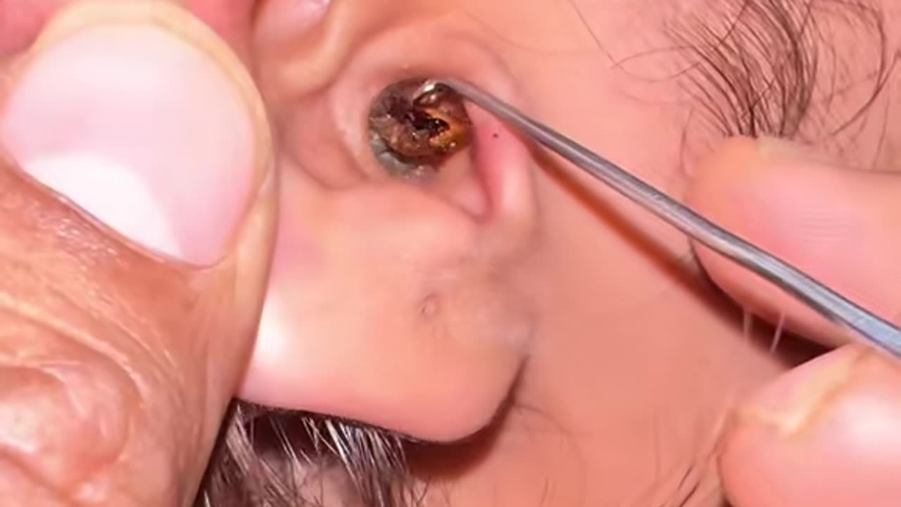 Earwax removal