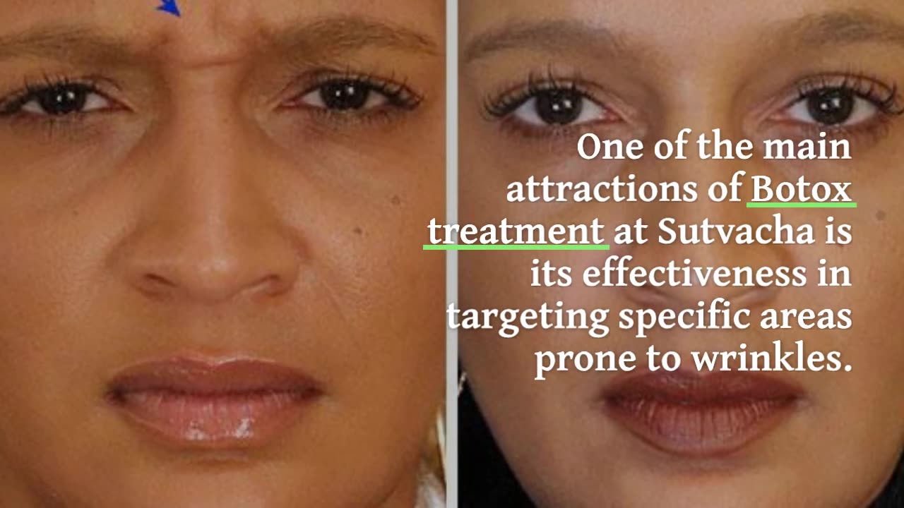 Sutvacha: Kolkata's Premier Destination for Botox Excellence.