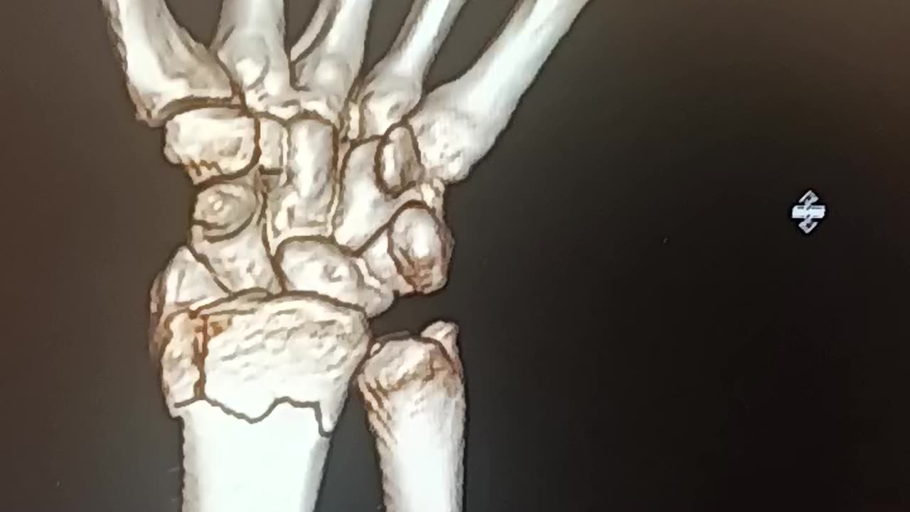 3DCrashWrist