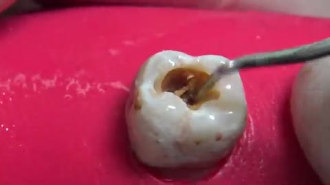 Dentista quitando la CARIES dental _ Increible transformación en