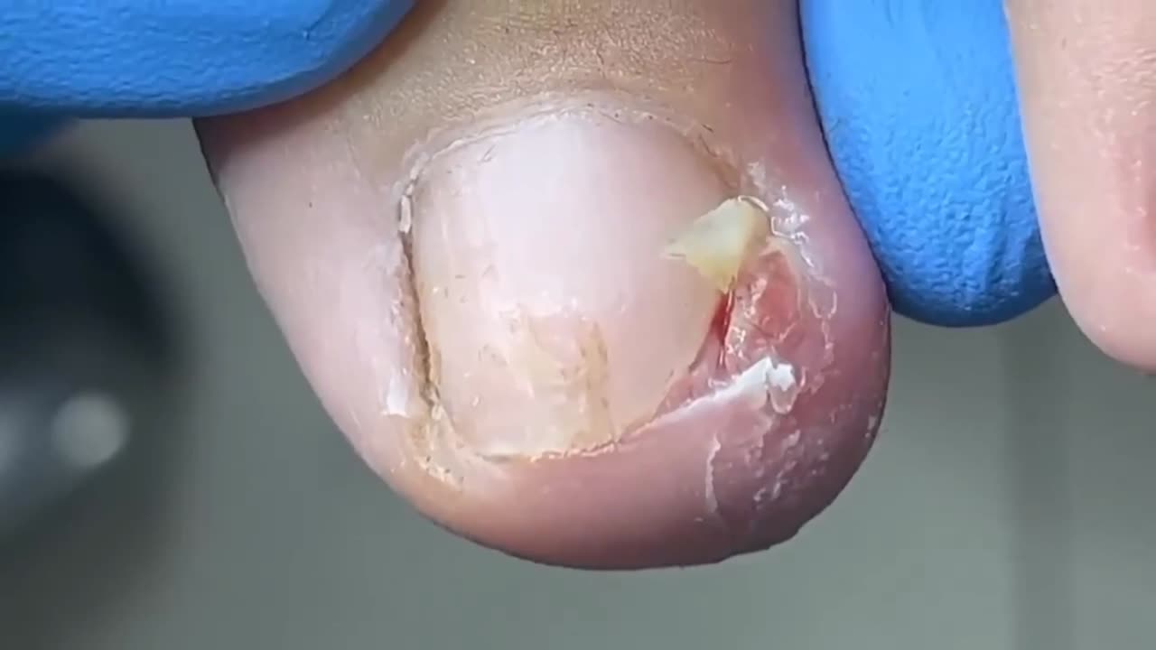 Ingrown toenail removal 😱😱