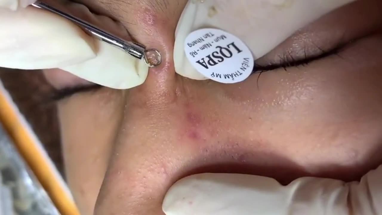 Blackhead and Whitehead Extraction | Satisfying