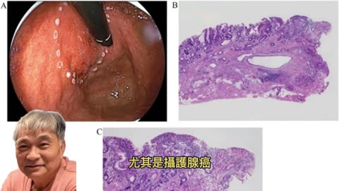 攝護腺健康 嚴重恐腎衰竭