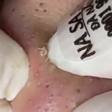Black heads removal