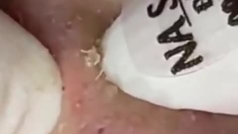 Black heads removal