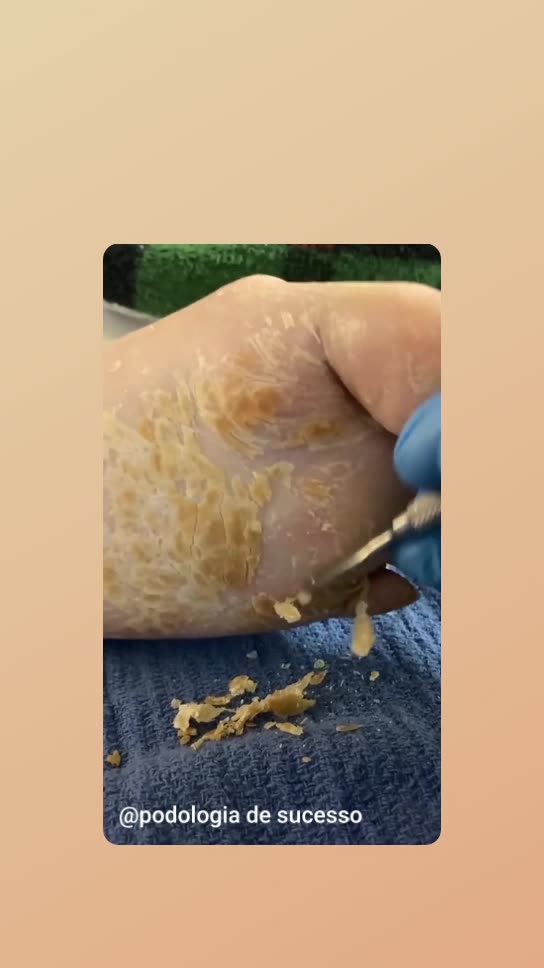 Foot callus removal