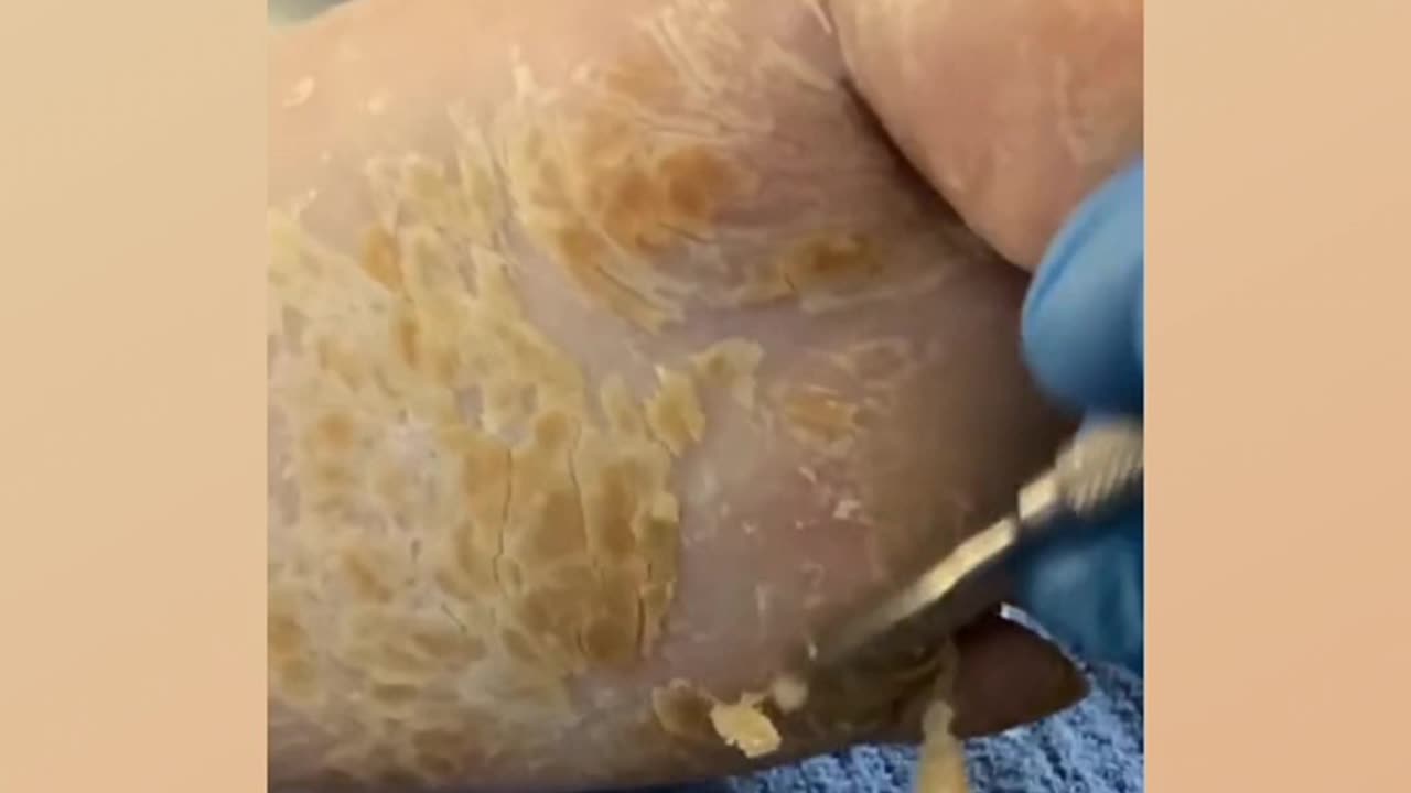 Foot callus removal