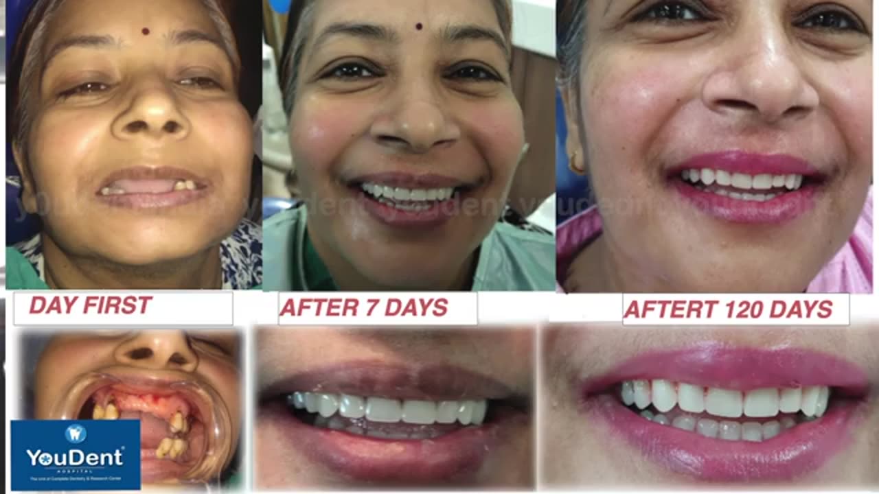 Smile Makeover in jaipur